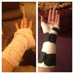 Cast on the left, splint on the right.